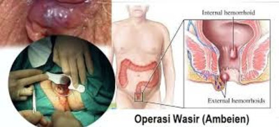 Jual Ambejoss Salep Salwa Obat Wasir De Nature Di Ternate