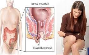 Jual Ambejoss Salep Salwa Obat Wasir De Nature Di Sumedang