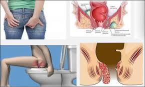 Jual Ambejoss Salep Salwa Obat Wasir De Nature Di Pacitan